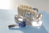 Implantate Zahn + Implantat
